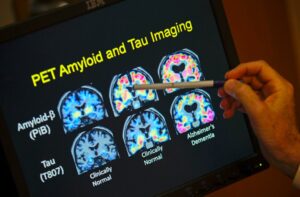 FDA OKs first blood test that can help diagnose Alzheimers disease